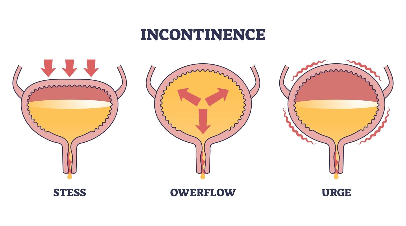 Stress Urinary Incontinence - Rela Hospital