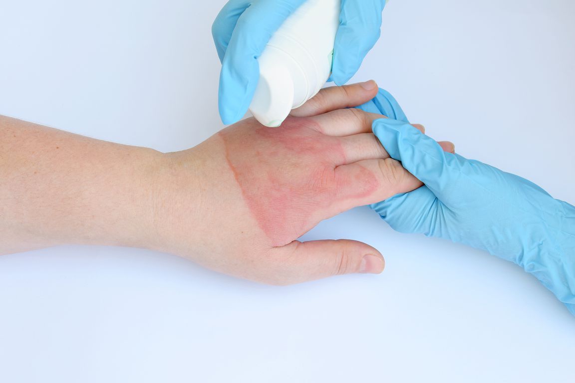 熱傷治療マニュアル = CURRENT TREATMENT FOR BURN … An Overview of Recent Developments in the Management of Burn