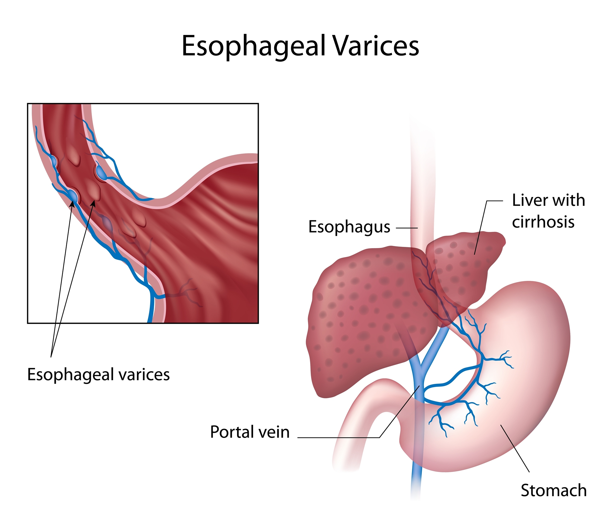 endoscopic evl