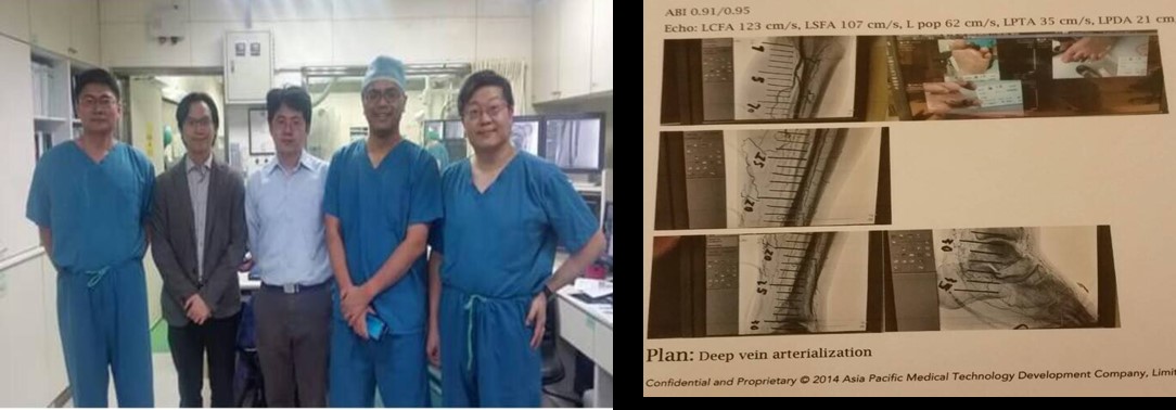 Completed the first case of East Asia, Taiwan, the world's eighth case of Deep vein arterialization