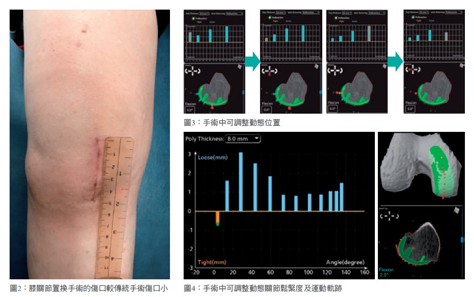 邁向人工關節置換新紀元淺談微創 精準 動態 三維及定量的機器手臂輔助關節置換術 中國醫藥大學附設醫院