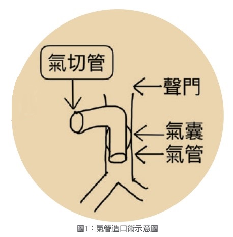 圖1：氣管造口術示意圖