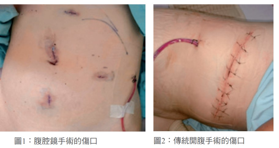 達文西機器手臂部分腎切除手術 Robotic Partial Nephrectomy Surgery 醫療新聞 中國醫藥大學附設醫院