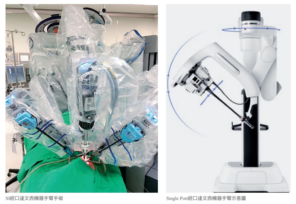 達文西機器手臂 頭頸癌的應用手術 醫療新聞 中國醫藥大學附設醫院