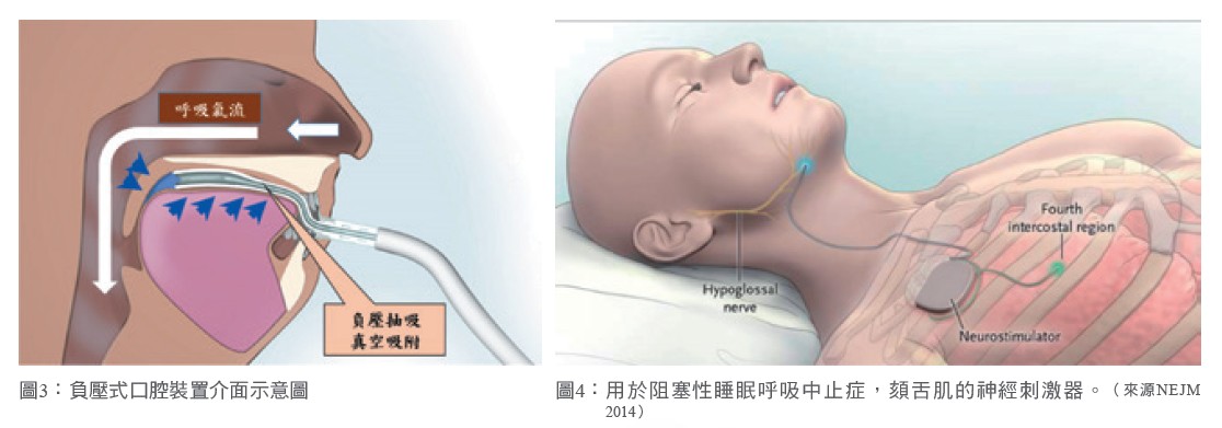 治療阻塞性睡眠呼吸中止症除了陽壓呼吸器之外的選擇 中國醫藥大學附設醫院