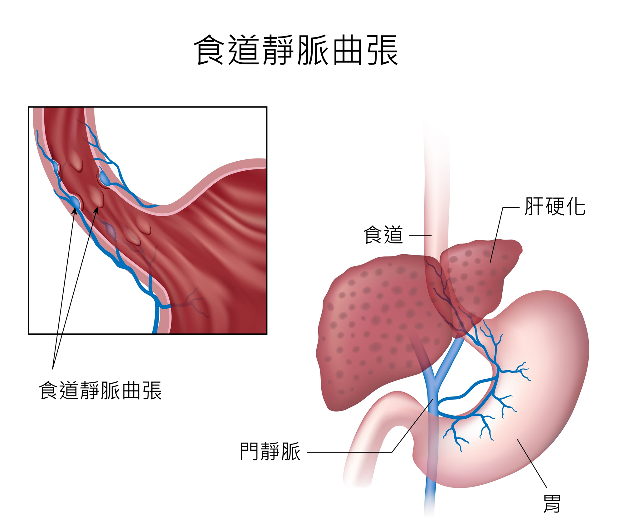 食道靜脈曲張及出血| 衛教單張- 中國醫藥大學附設醫院