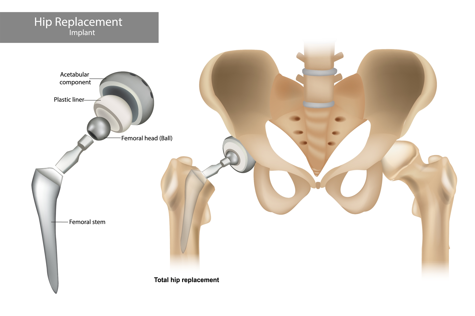 Getting to know Artificial Hip Joint Replacement Surgery 認識人工 