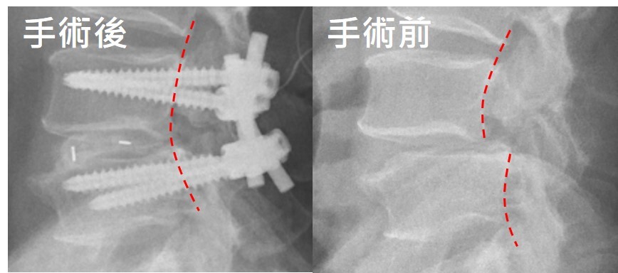 Spondylolisthesis 脊椎滑脫 | 衛教單張 - China Medical University 