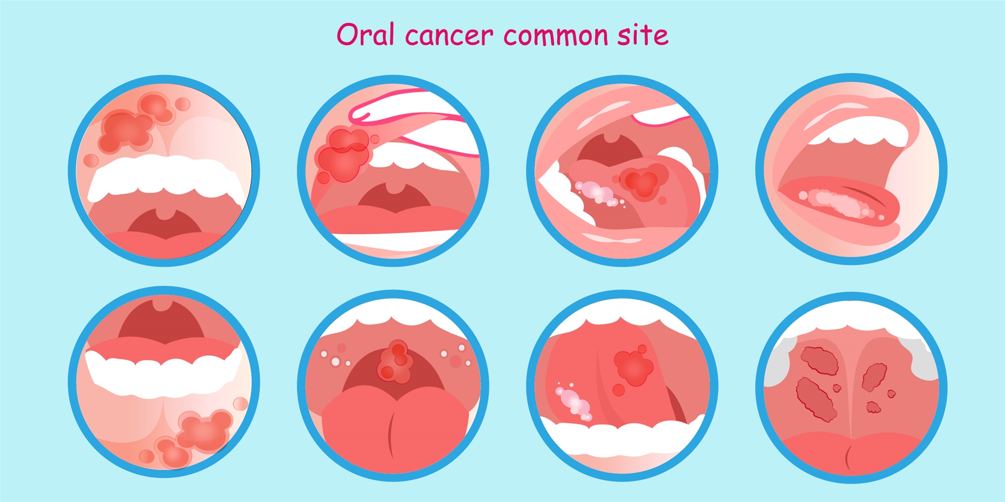 Oral Cancer 了解口腔癌| 衛教單張- 中國醫藥大學附設醫院