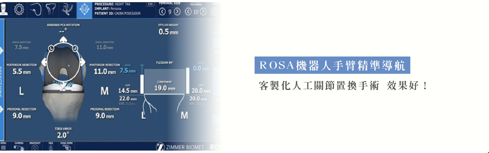 ROSA機器人手臂精準導航  客製化人工關節置換手術 效果好！