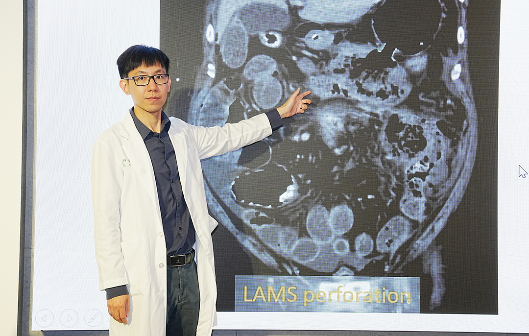 前往 小小膽結石恐引發壞死性胰臟炎 中醫大附醫多專科團隊合力逆轉重症 大幅提升存活率