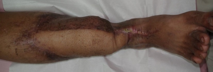 術後, 右小腿脛骨骨髓炎或德良好控制