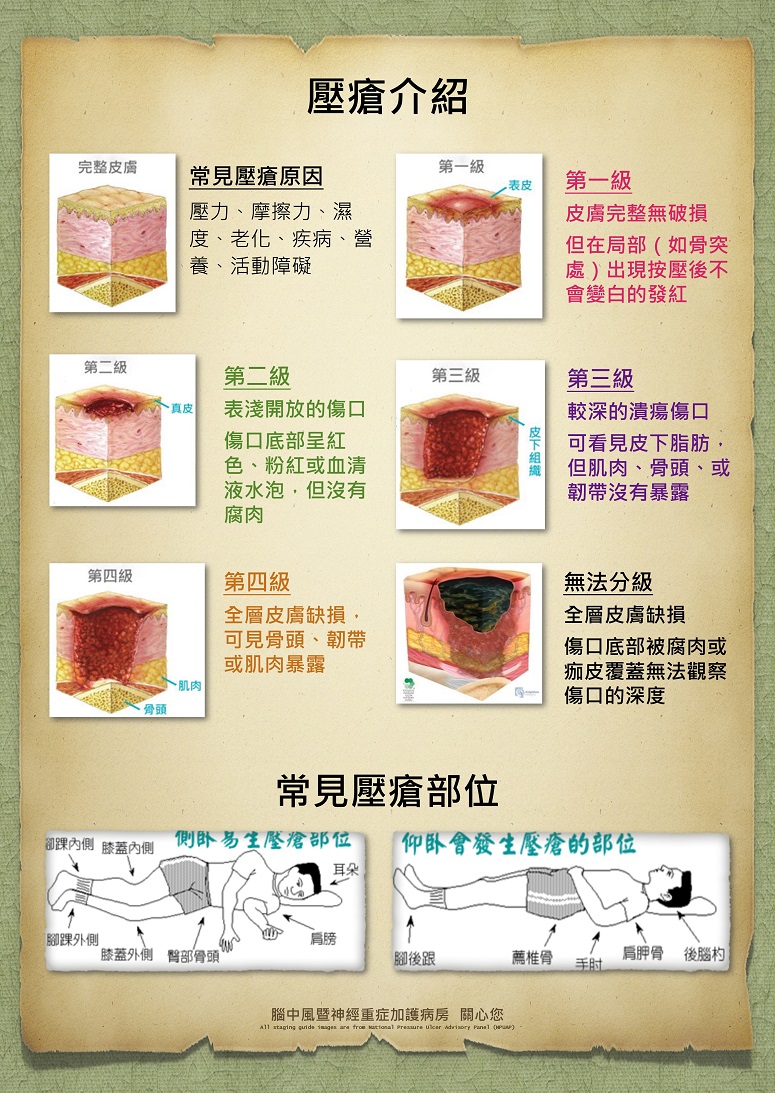 壓瘡介紹 衛教海報 中國醫藥大學附設醫院