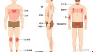 壓力性損傷的預防與治療