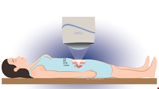 子宮肌瘤治療新選擇-海芙消融治療術(HIFU)