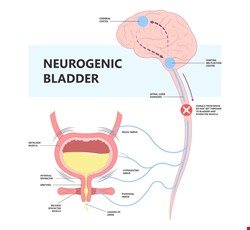 Neurogenic Bladder 神經性膀胱