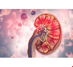 Kidney Stone Prevention 腎結石預防措施