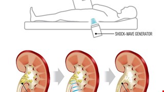 Instructions for Department of Urology  Shock Wave Lithotripsy Outpatient Patients 泌尿科門診碎石病人須知