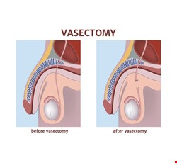 Precautions for Vasectomy 輸精管結紮注意事項
