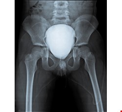 Urethral Stricture 尿道狹窄