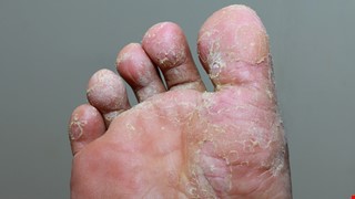 Tinea Pedis 足癬