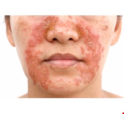 Seborrheic Dermatitis 脂漏性皮膚炎