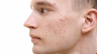 Acne Skincare 痤瘡皮膚保養