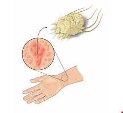 Prevention and Treatment of Scabies 疥瘡的預防與治療
