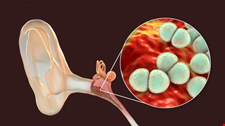 中耳炎手術與注意事項