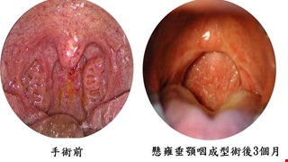 打鼾與睡眠呼吸中止症候群