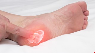 Plantar Fasciitis 足底筋膜炎