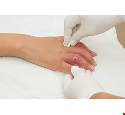 急診—人工皮使用方法