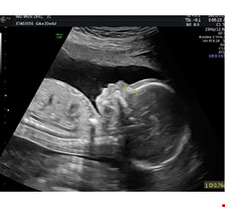 Comparison Chart between Level II Ultrasound & NHI Gynecologic Ultrasound 胎兒高層次超音波＆健保超音波比較表