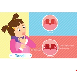 Acute Tonsilliti 兒童扁桃腺炎