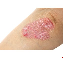 Psoriasis Prevention and health 乾癬的預防與保健