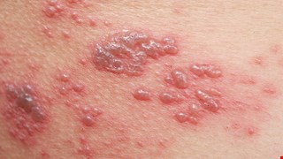 Risk and Prevention of Herpes Zoster in Patients with Chronic Kidney Disease 慢性腎病病人的帶狀疱疹風險與預防