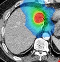 立體定位放射治療早期肺癌