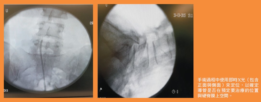 手術過程中使用即時X光（包含 正面與側面）來定位