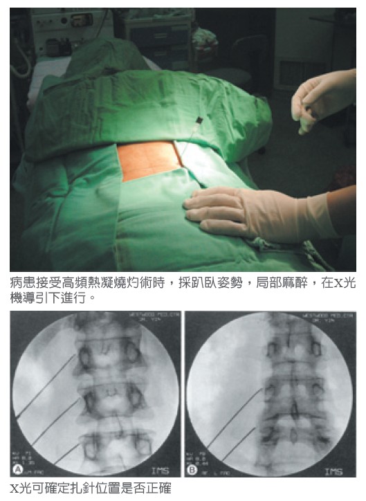 病患接受高頻熱凝燒灼術時，採趴臥姿勢，局部麻醉，在X光機導引下進行。