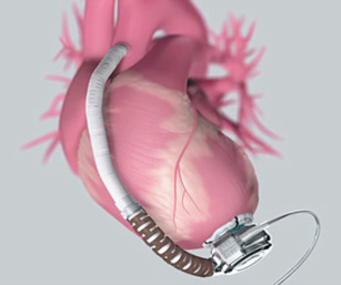 心臟裝置新型心室輔助系統後的示意圖