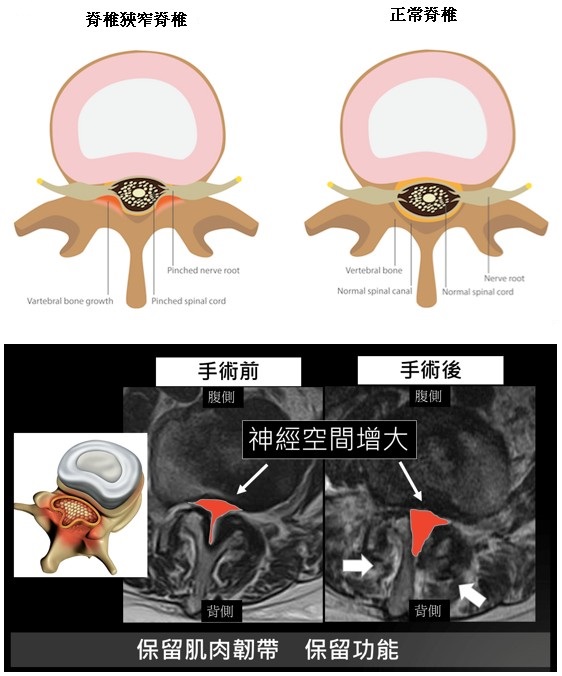 微創脊椎手術新選擇：脊椎內視鏡手術演進和介紹