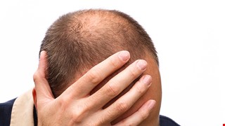 成功男性頭頂永遠的痛 談雄性禿的成因與治療