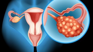 提高卵巢癌療效 腹腔內化療溫熱療法巧妙助攻