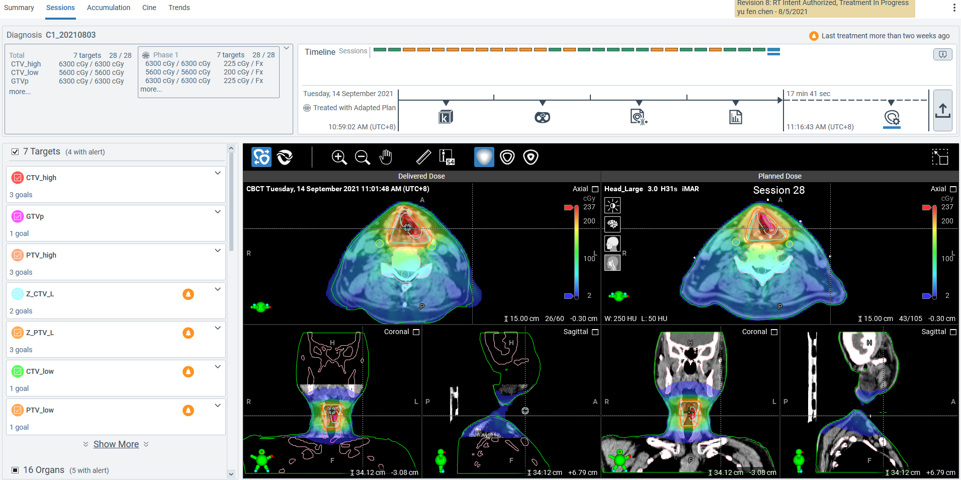 中國附醫放射腫瘤科完成國內首例每日自適應性放射治療，成效良好