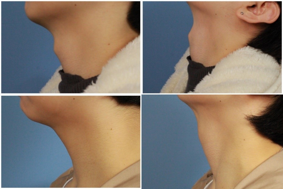 喉結手術、無疤痕喉結減積手術 （Scarless Thyroid Cartilage Reduction）