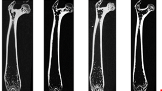 Dickkopf-1 (DKK1) blockade mitigates osteogenesis imperfecta (OI) related bone disease