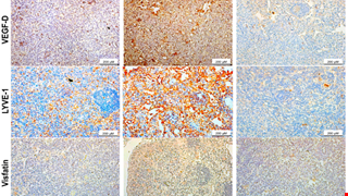 Visfatin Facilitates VEGF-D-Induced Lymphangiogenesis through Activating HIF-1α and Suppressing miR-2277-3p in Human Chondrosarcoma