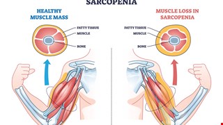 Impact of sarcopenia on outcomes following lumbar spine surgery for degenerative disease: an updated systematic review and meta-analysis