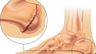 Comparison of the Radiographic and Clinical Outcomes between the Sinus Tarsi and Extended Lateral Approaches for Intra-Articular Calcaneal Fractures: A Retrospective Study