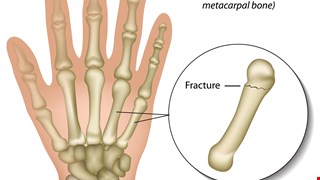 Biomechanical analysis of plate versus K-wire fixation for metacarpal shaft fractures with wedge-shaped bone defects